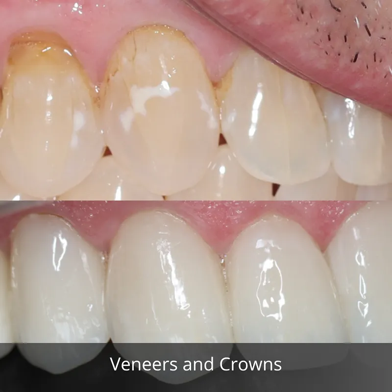 veneers and crowns 1