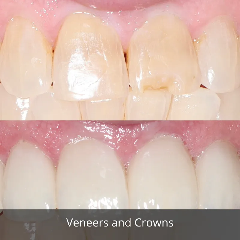 veneers and crowns 2
