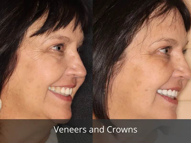 veneers and crowns 3