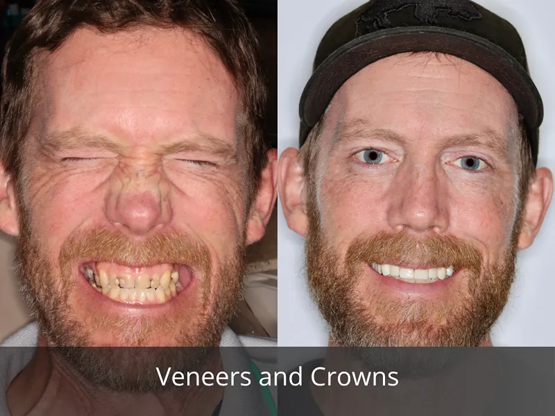 veneers and crowns 4