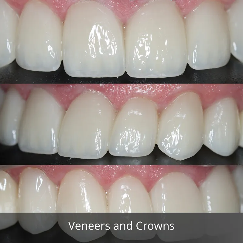 veneers and crowns 5